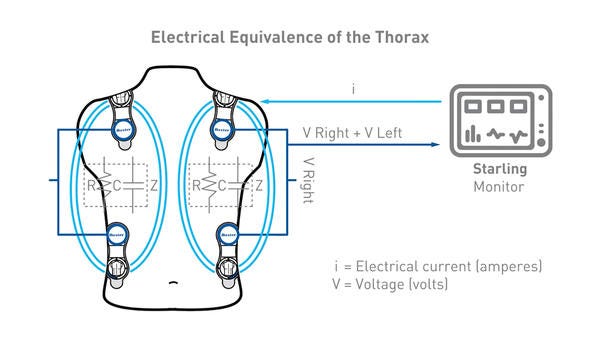 Video thumbnail illustrating sensors placed on the thorax connected to the Starling monitor
